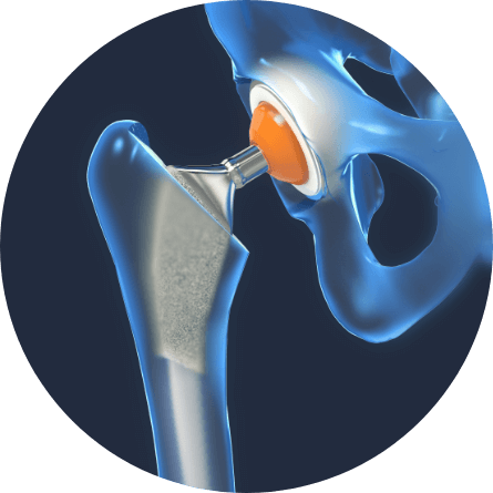 illustration of hip replacement technology